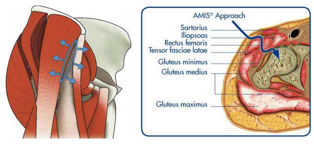 Studies Confirm Benefits of Direct Anterior Approach to Total Hip  Replacement - OrthoMaryland