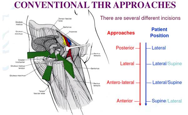 Total Hip Replacement Surgery, Direct Anterior Approach (DAA)